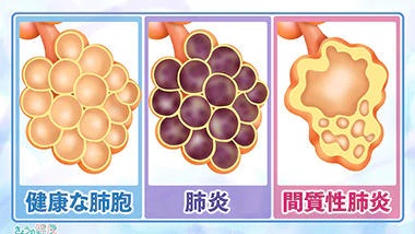 画像は　NHK　健康ｃｈ　息切れなどの症状が出る「間質性肺炎」とは？原因や治療法を解説　を利用させて頂きました。　